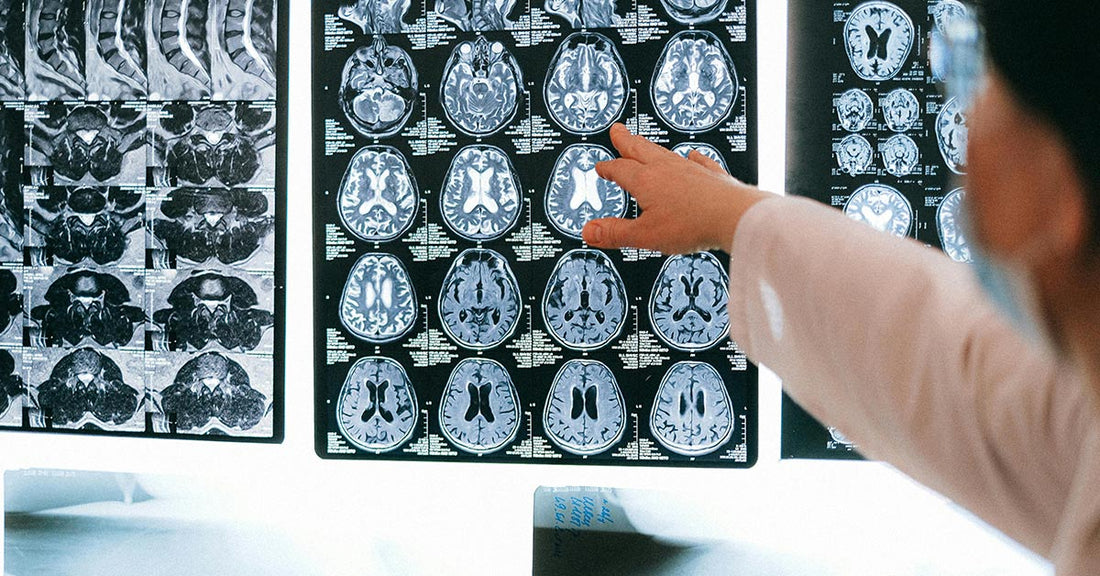 Microplastic Exposure and Alzheimer’s Risk in Genetically Vulnerable Individuals