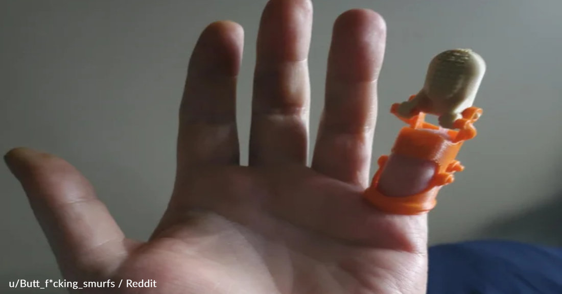 Reddit Steps In To Help When Man Needs A New Prosthetic Finger