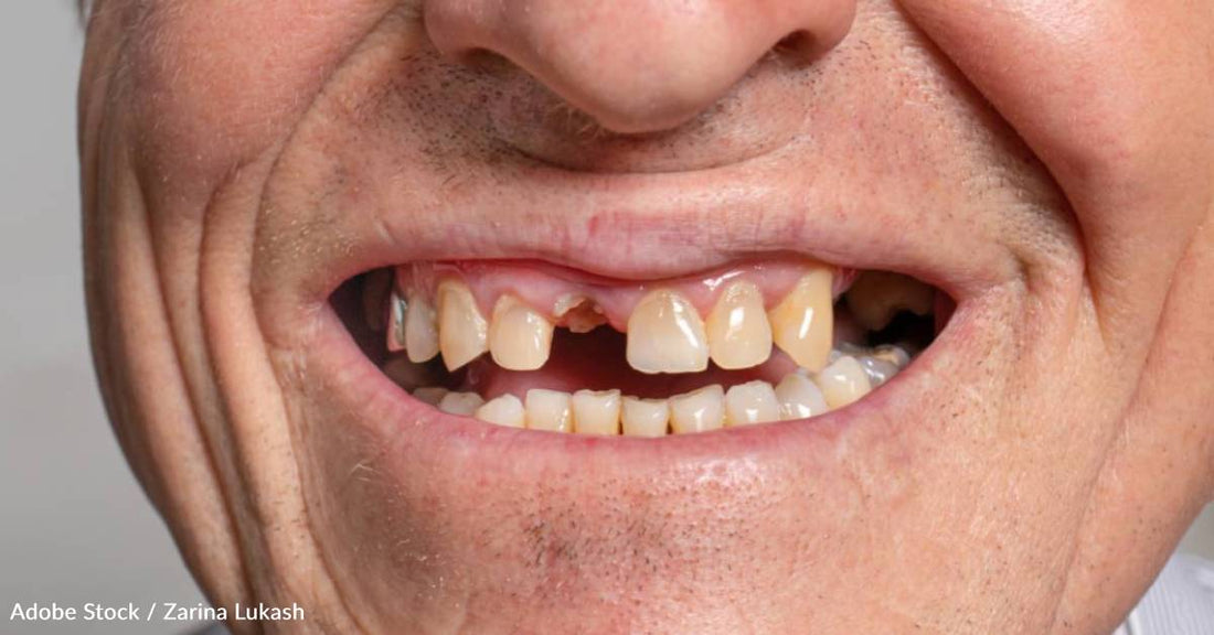 Having Both Diabetes and Tooth Loss May Hasten Cognitive Decline