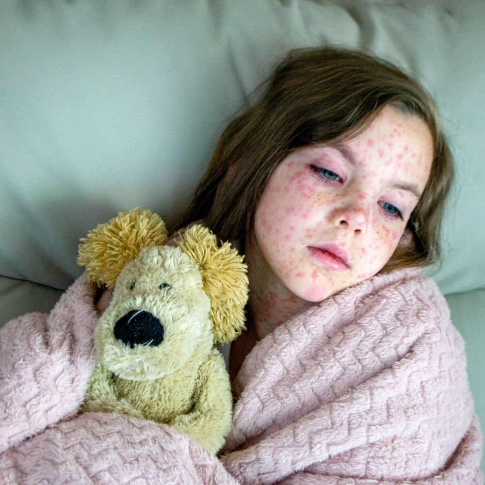 A young girl with a red spotted rash lies resting in bed, wrapped in a pink blanket and hugging a stuffed animal toy.